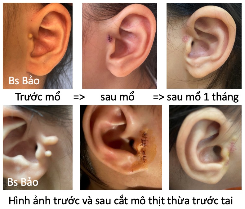 Mô thịt thừa trước tai trẻ 