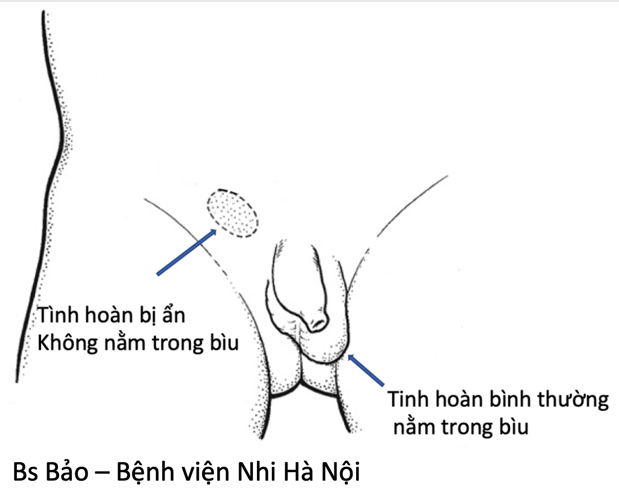 Dấu hiệu trẻ bị ẩn tinh hoàn