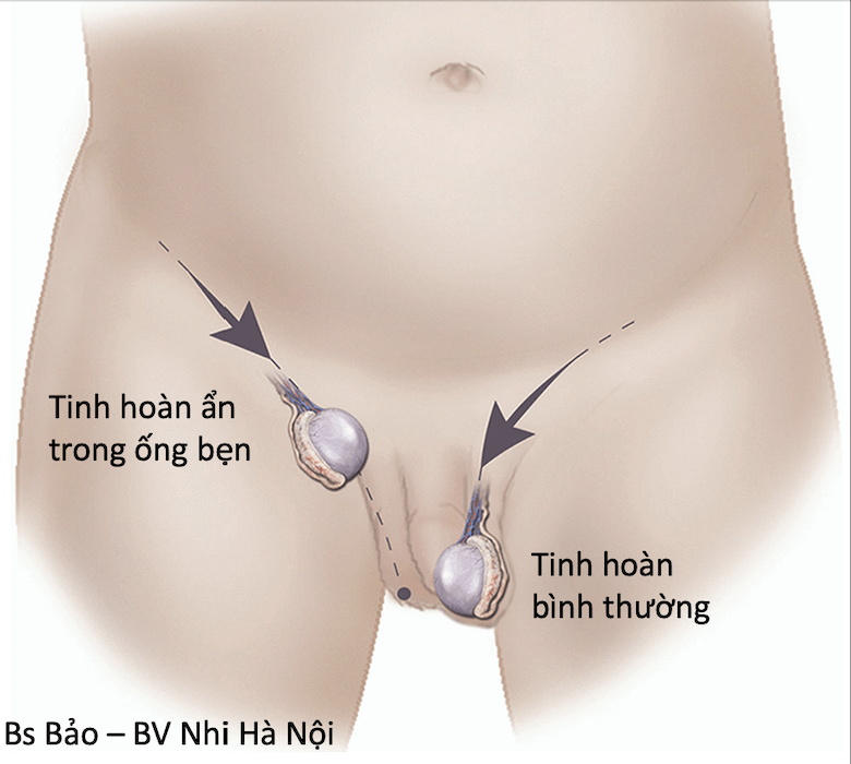 Điều trị ẩn tinh hoàn ở trẻ em